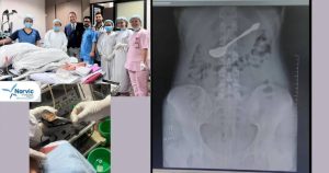 नर्भिकका चिकित्सकले बिना शल्यक्रिया निकाले १७ वर्षीया किशोरीको पेटमा अड्किएको चम्चा