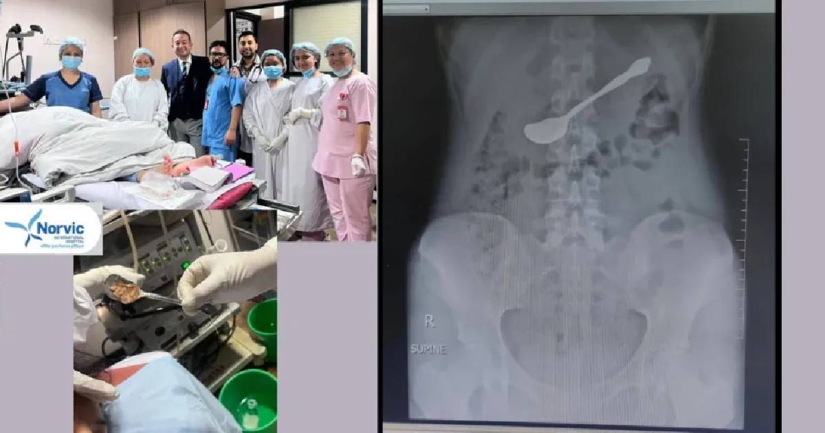 नर्भिकका चिकित्सकले बिना शल्यक्रिया निकाले १७ वर्षीया किशोरीको पेटमा अड्किएको चम्चा